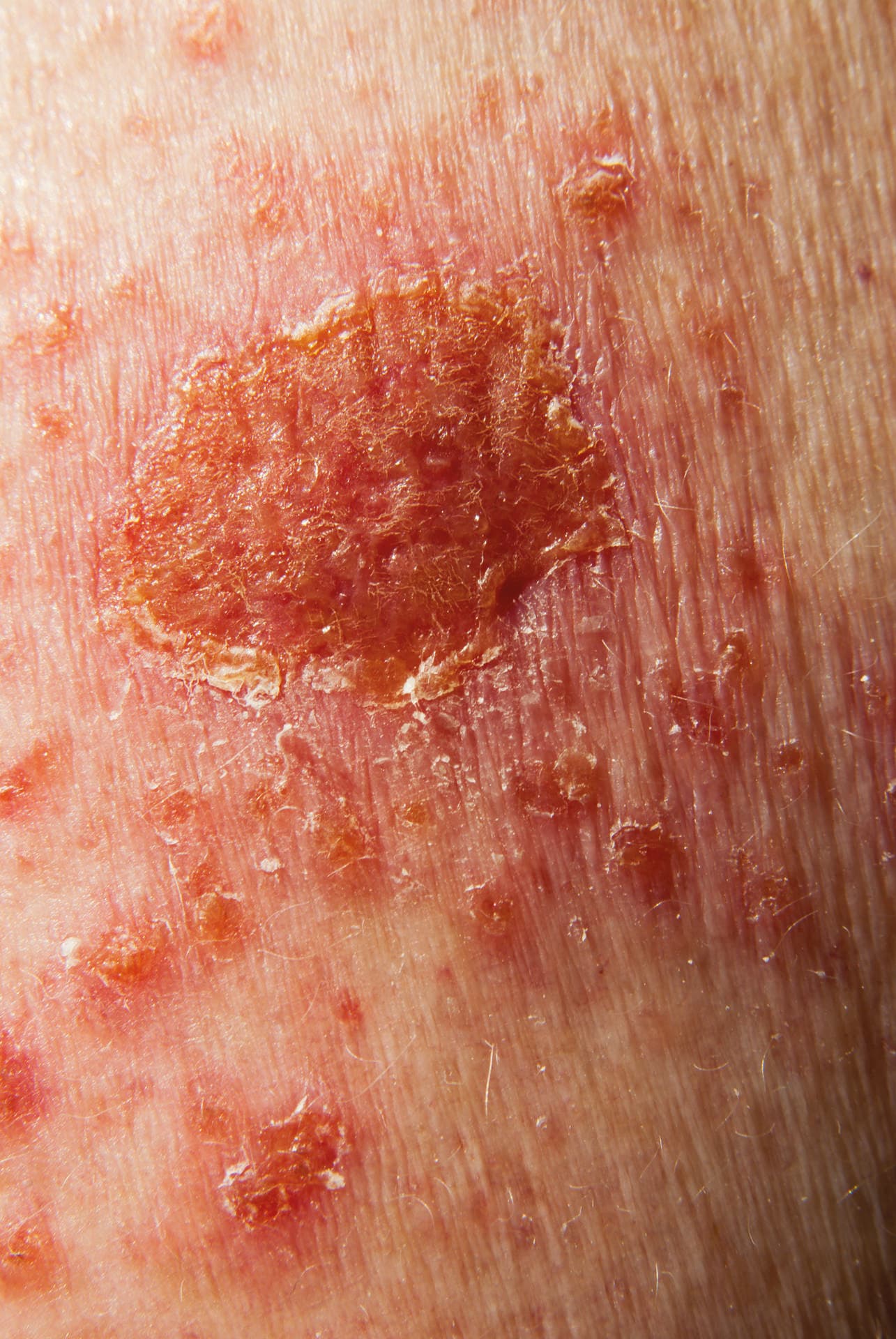 Basalzellkarzinom-Krebsbehandlung mit topischer Medizin