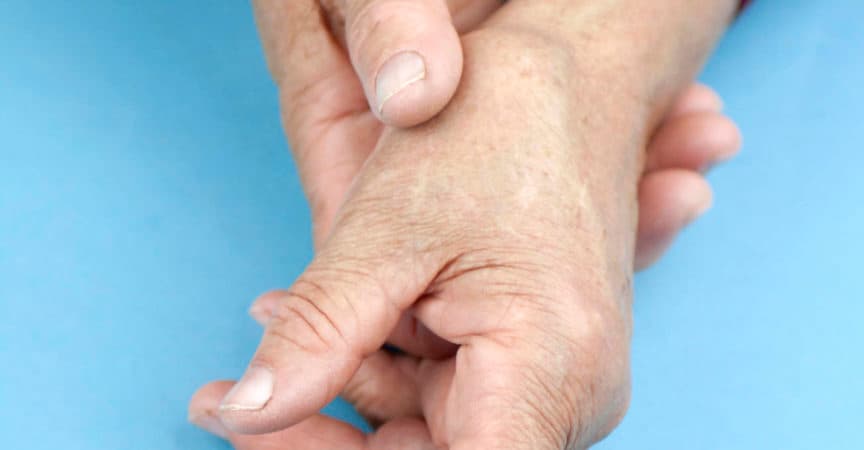 Hände einer Frau, die an rheumatoider Arthritis verformt ist