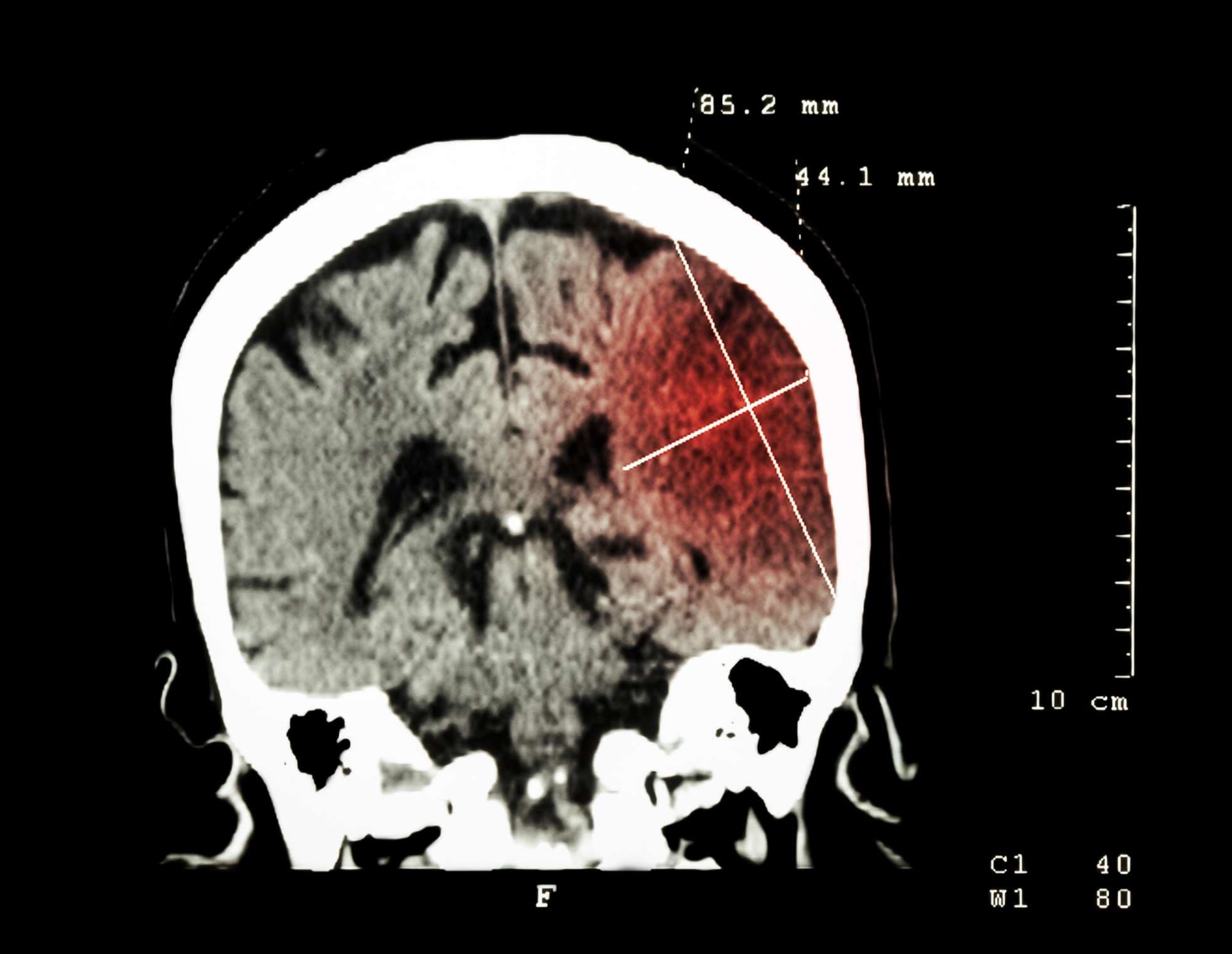 Hirninfarkt in der linken Hemisphäre (ischämischer Schlaganfall) (CT-Scan des Gehirns): Hintergrund in Medizin und Wissenschaft