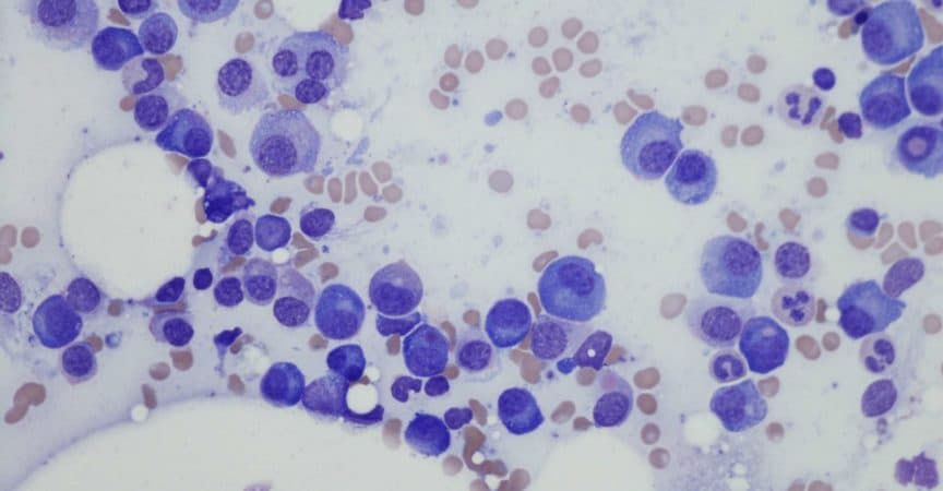 Plasmazellmyelom aus Knochenmarkaspirat.
