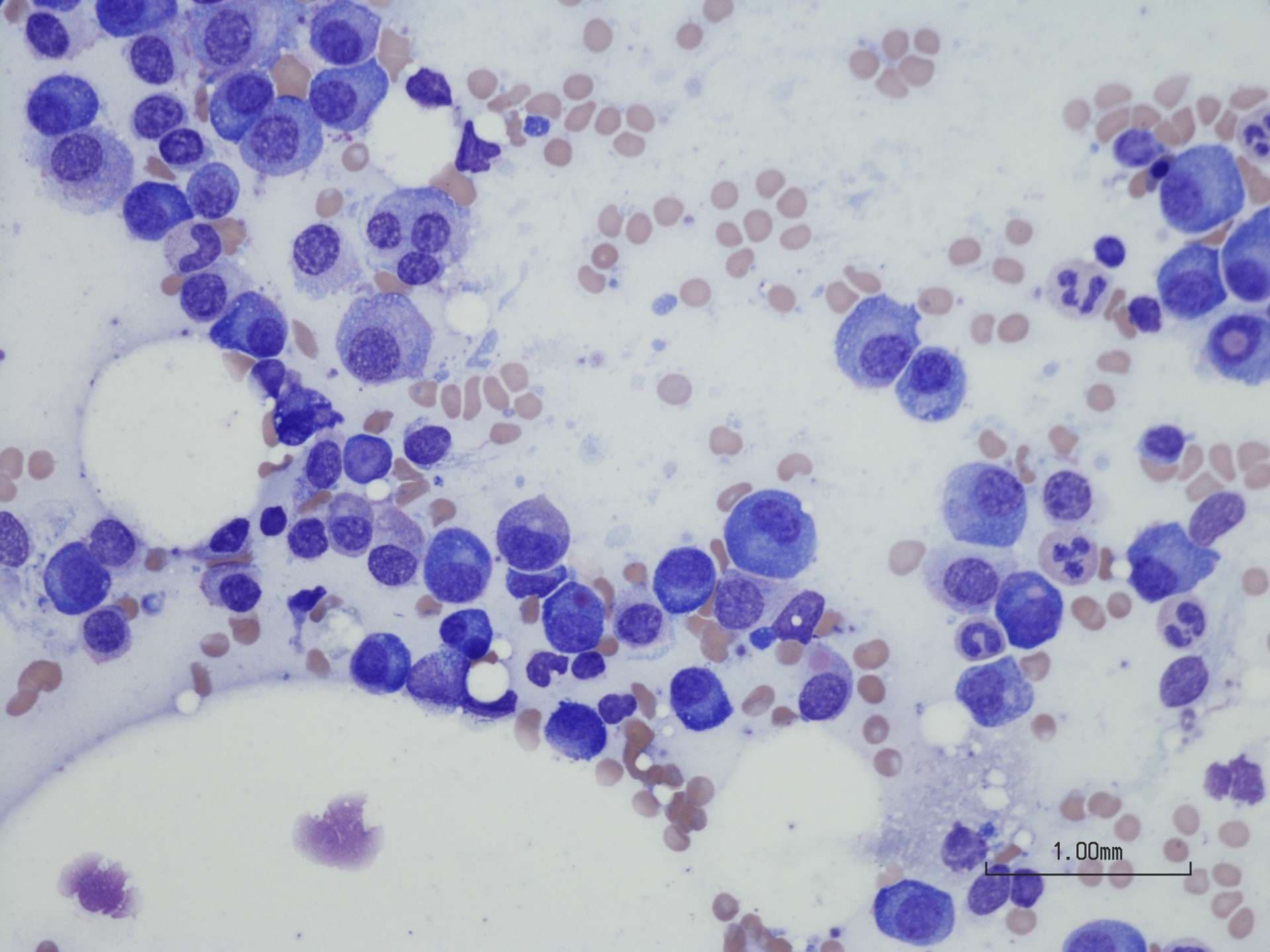 Plasmazellmyelom aus Knochenmarkaspirat.
