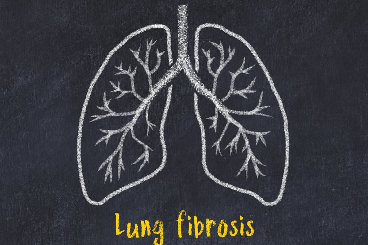 Konzept des Medizinstudiums. Kreidezeichnung einer Lunge mit der Aufschrift „Lungenfibrose“.