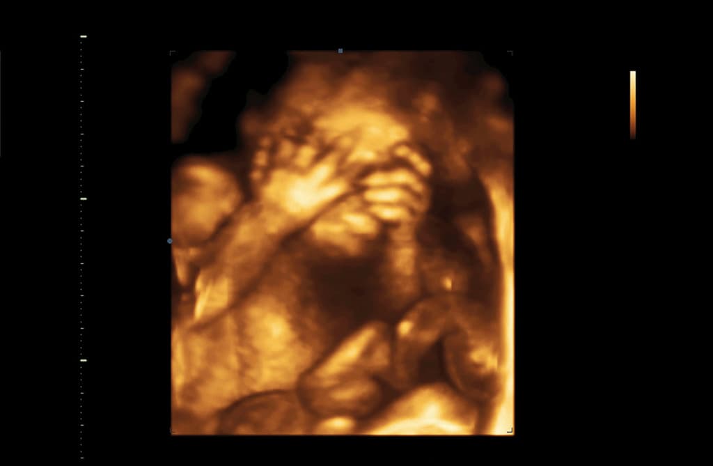 Baby 3D Ultraschall 6 Monate