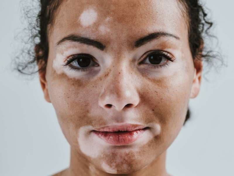Schöne Frau mit Vitiligohaut, die im Studio aufwirft. Konzept über Körperpositivität und Selbstakzeptanz