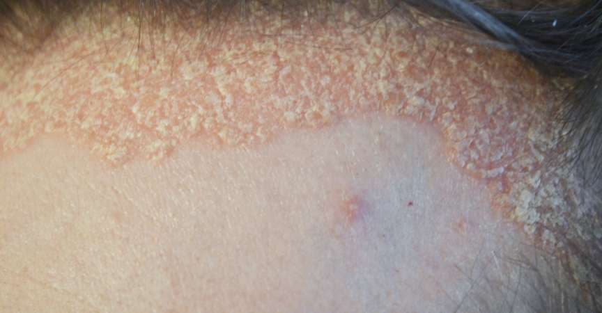 Schuppenflechte am Haaransatz und an der Kopfhaut - Nahaufnahme, dermatologische Erkrankungen
