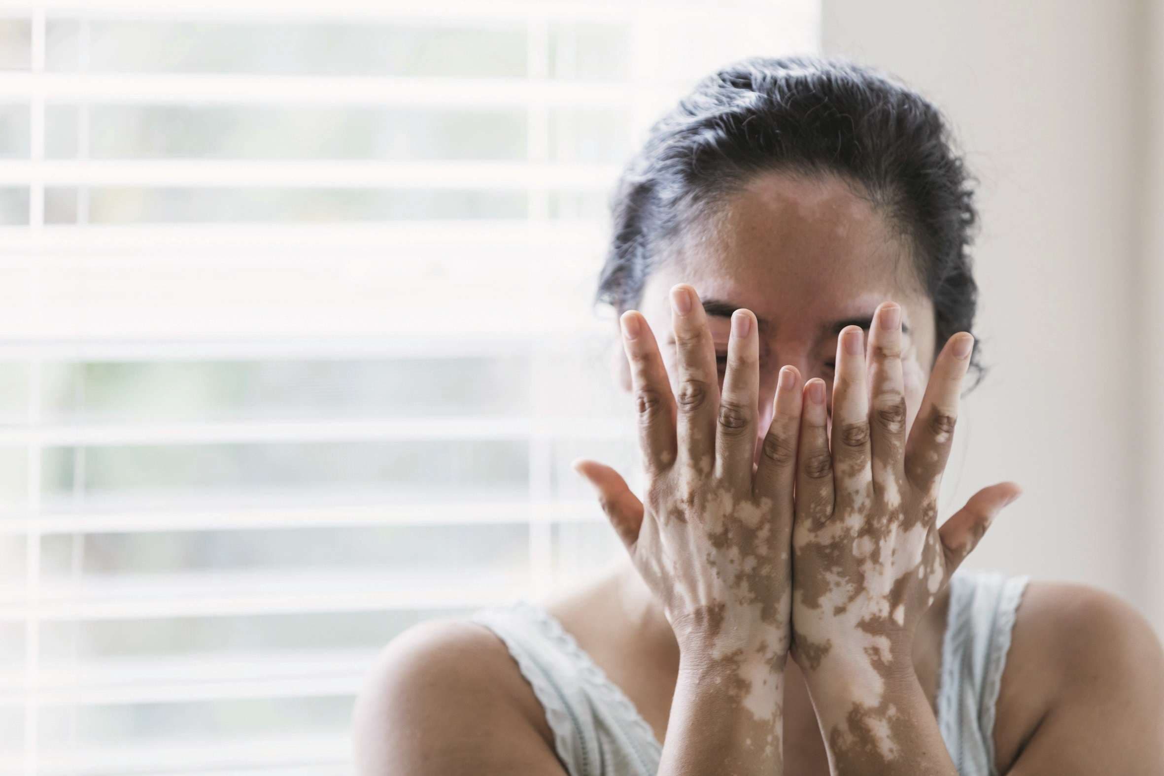Reife gemischtrassige Frau mit Vitiligo