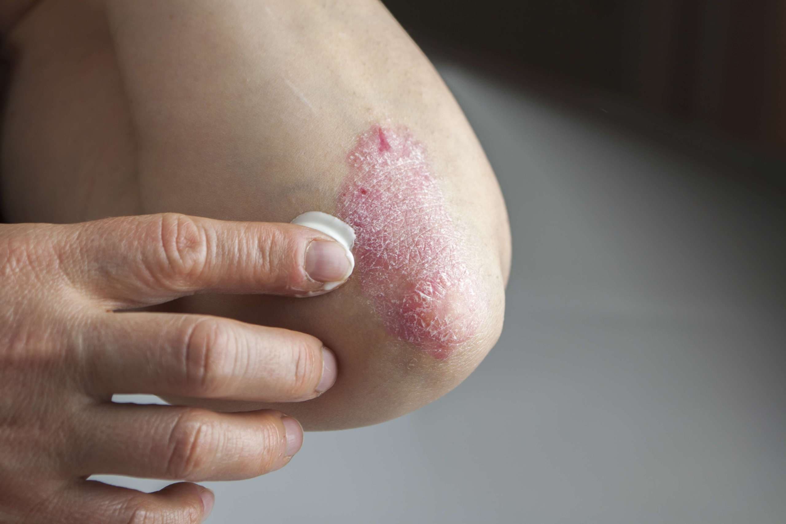 Psoriasis am Ellenbogen. Medizinische Behandlung