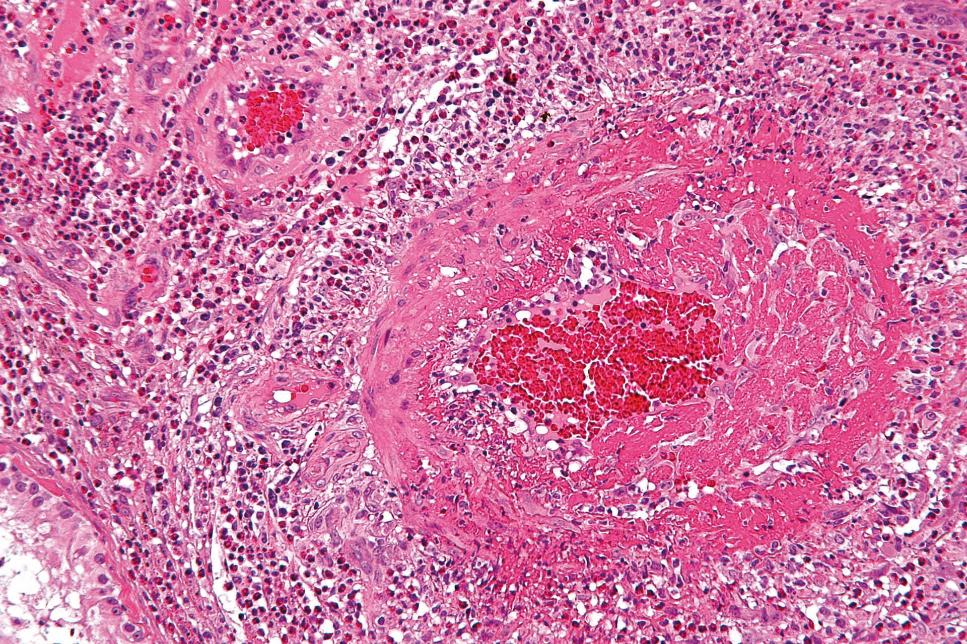 MO_AT_2022_KW05_MTA_wiki_Churg-Strauss_syndrome_-_high_mag