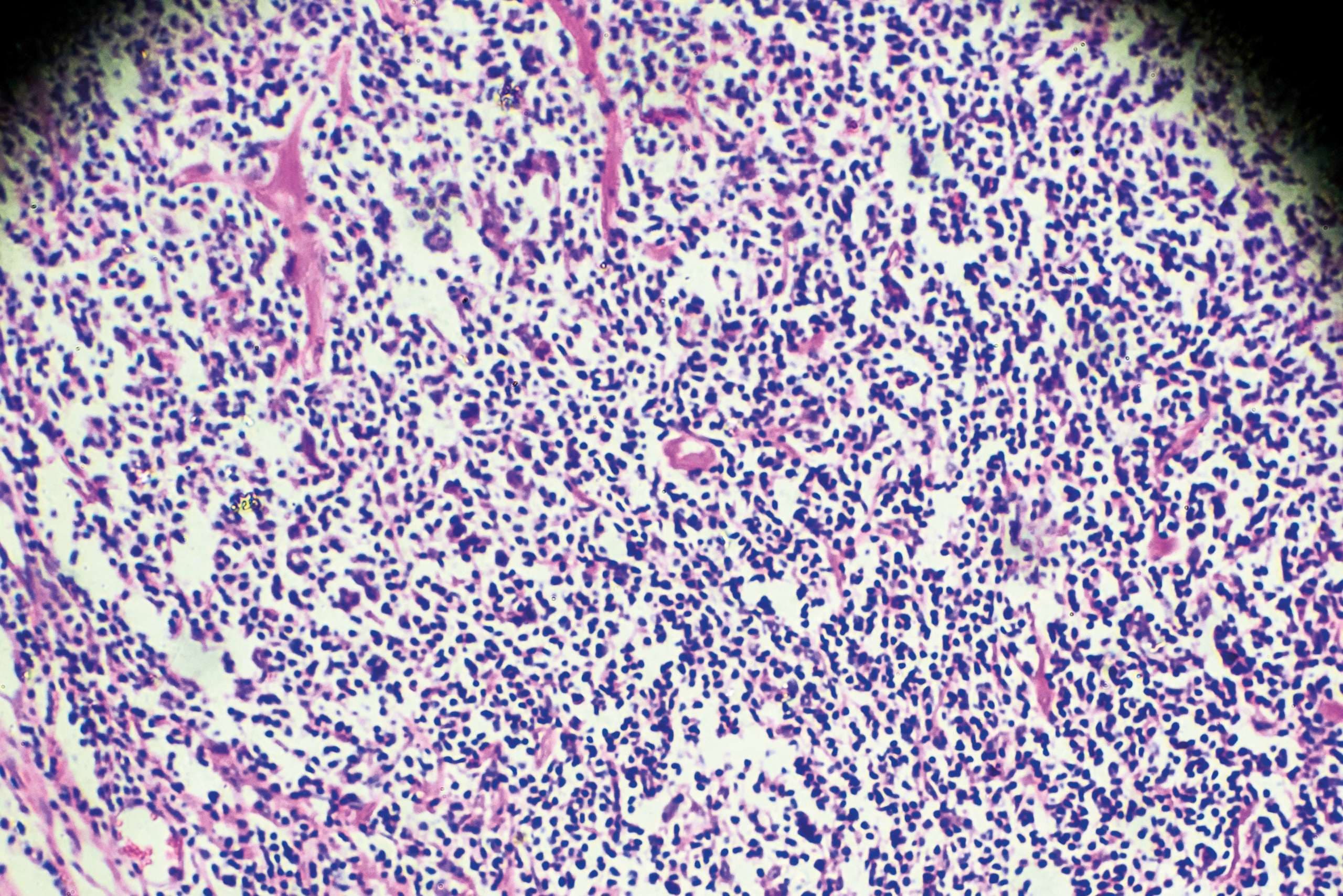 Hodgkin-Zellen-Krankheit, Lymphom, HL unter dem Mikroskop Zoom in verschiedenen Bereichen