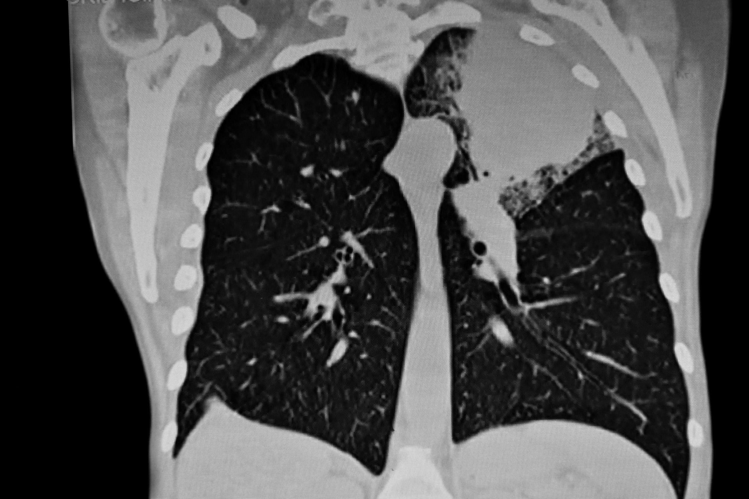 CAT-Scan: Tumor der linken oberen Lunge
