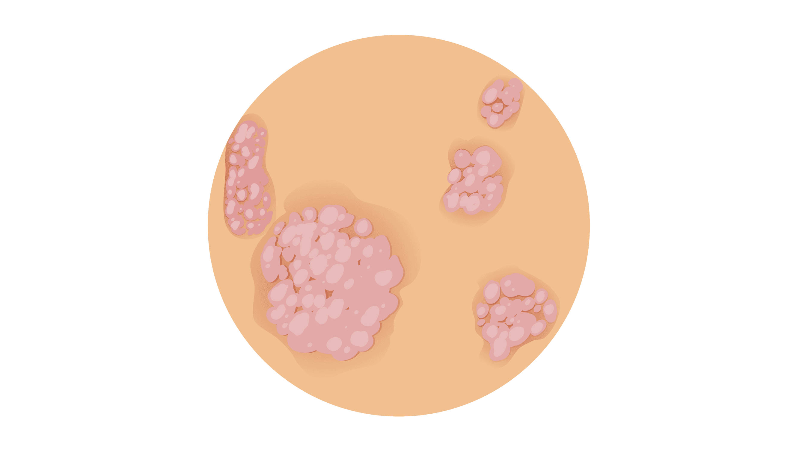 iStock-973682838-Psoriasis