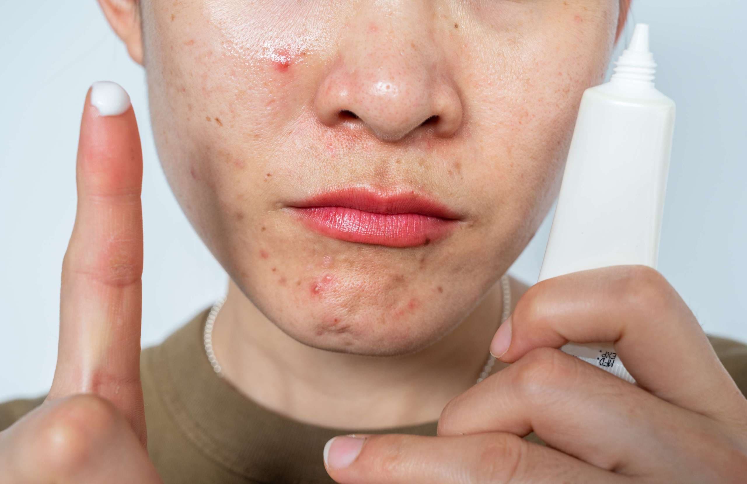 Konzeptionelle Aufnahme einer Frau beim Auftragen von Creme zur Verbesserung, Reinigung oder Behandlung ihrer Haut von Akne.