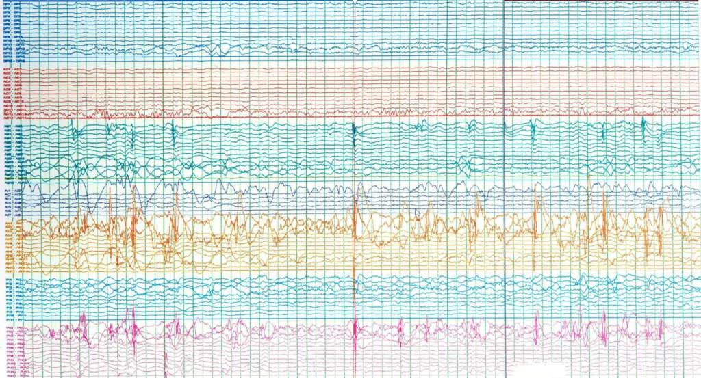 Gehirnwellen von Epilepsiepatienten