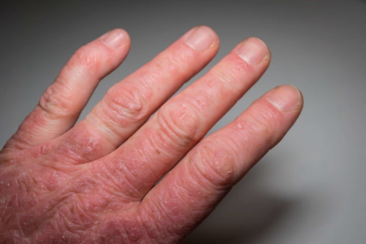 Hand of a psoriasis patient close-up. Psoriatic arthritis. Joint deformation and inflammation on the skin. Photo with dark vignetting. Soft focus