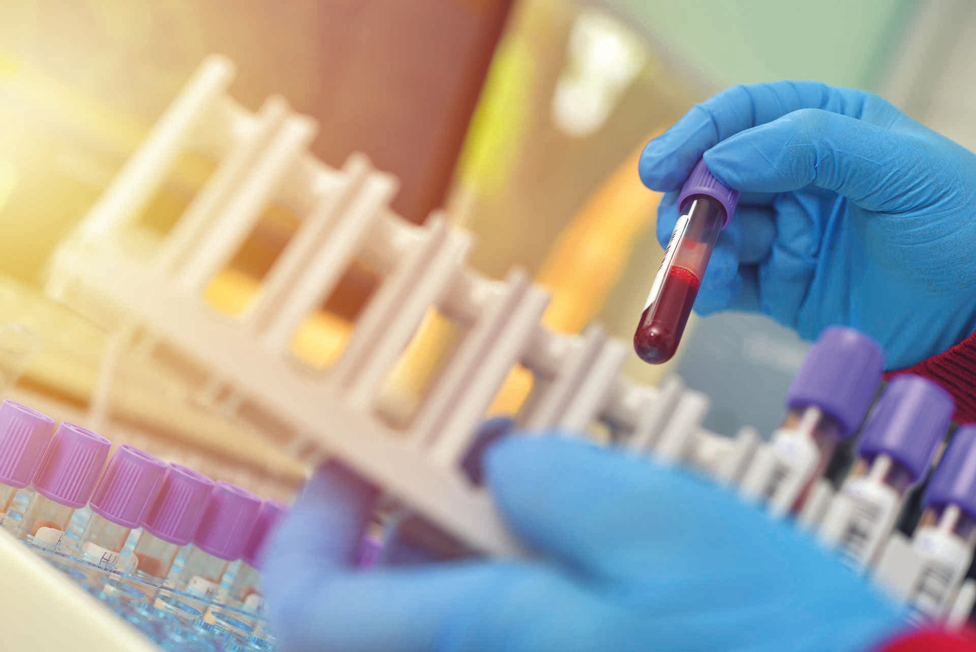 Röhrchen mit Blutproben zum Testen. Medizinische Ausrüstung