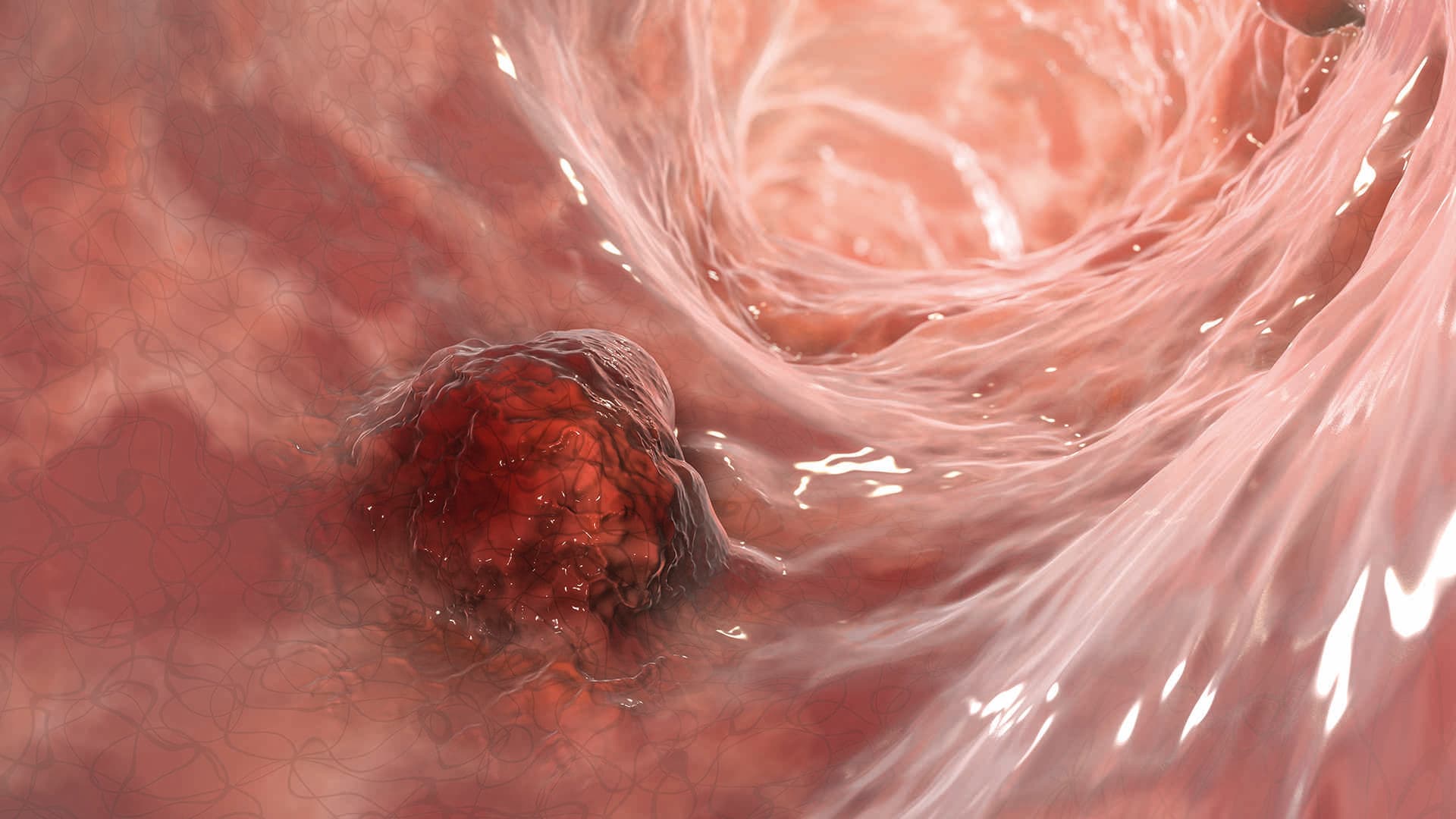 Darmkrebs, Darmkrebs, Darmneoplasie, 3D-Darstellung mit bösartigem Tumor im Darm