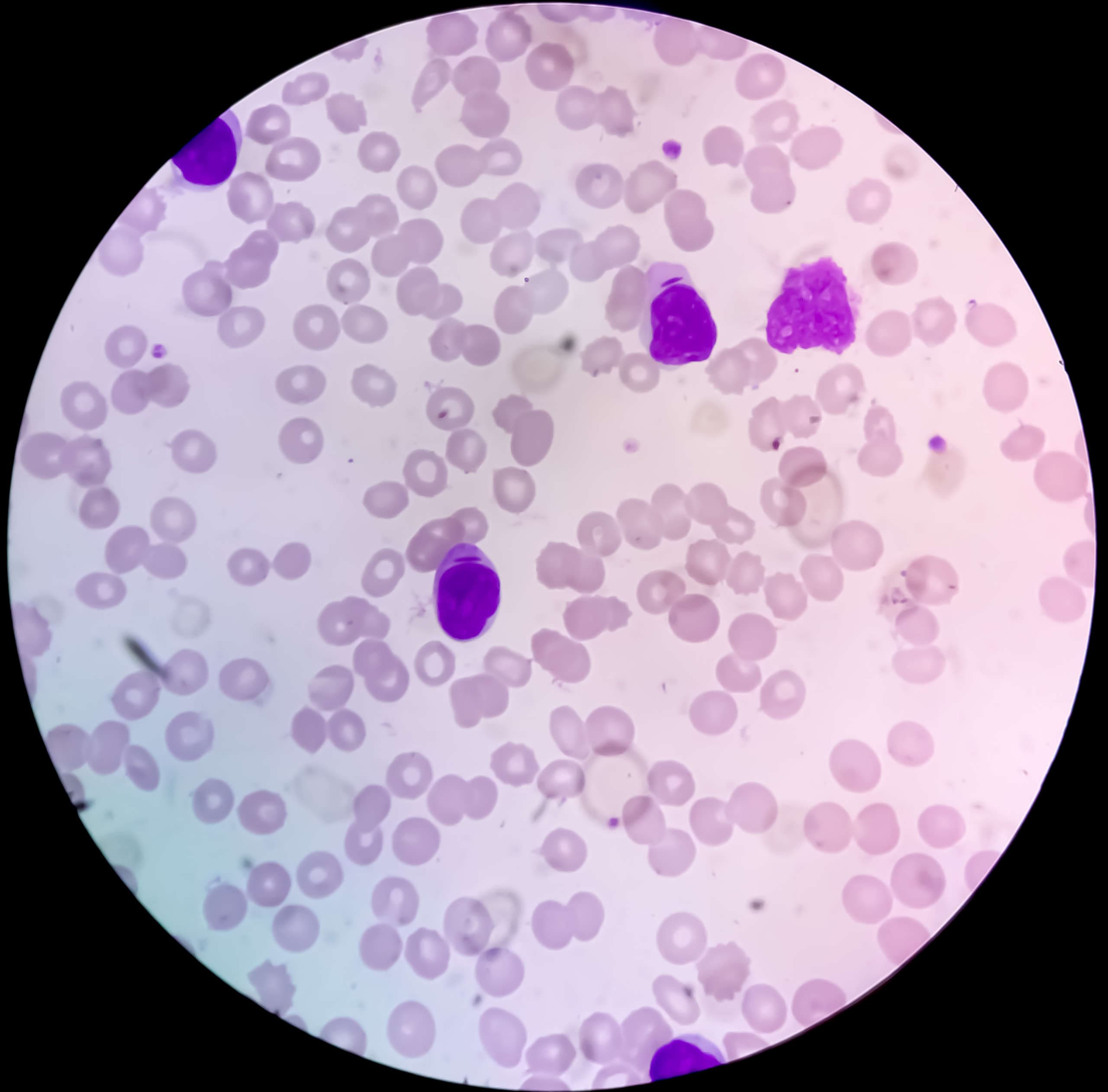 Myeloblasten mit Auer-Stäbchen bei akuter myeloischer Leukämie.