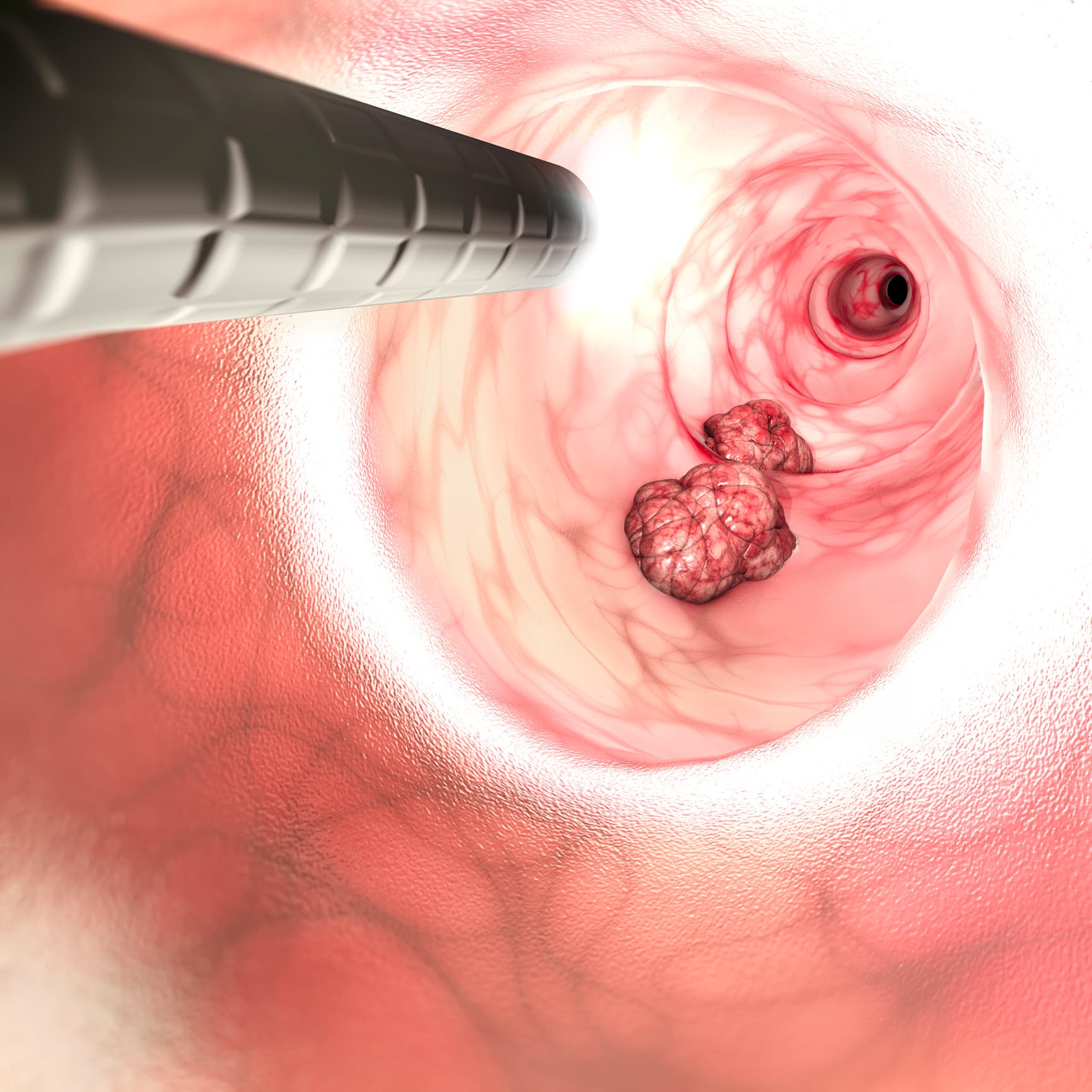 Innenansicht der Darmwände. Dickdarmkrebs (CRC), Darmkrebs, Dickdarmkrebs oder Mastdarmkrebs. Abnormales Wachstum von Zellen, die in andere Teile des Körpers eindringen oder sich dort ausbreiten. 3D-Rendering