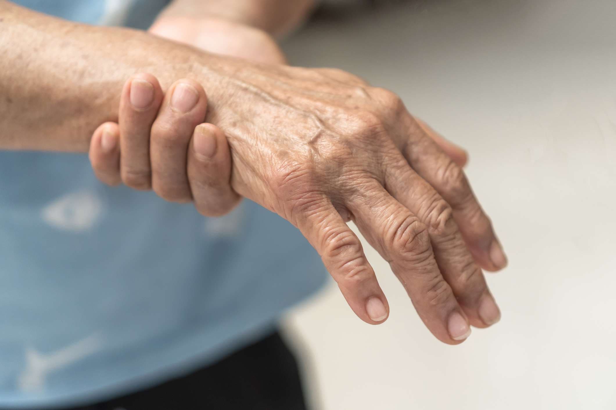 Guillain-Barre-Syndrom GBS, periphere Neuropathie Schmerzen bei älteren Patienten an Hand, Fingern, sensorischen Nerven mit taub, Muskelschwäche durch chronisch entzündliche demyelinisierende Polyneuropathie