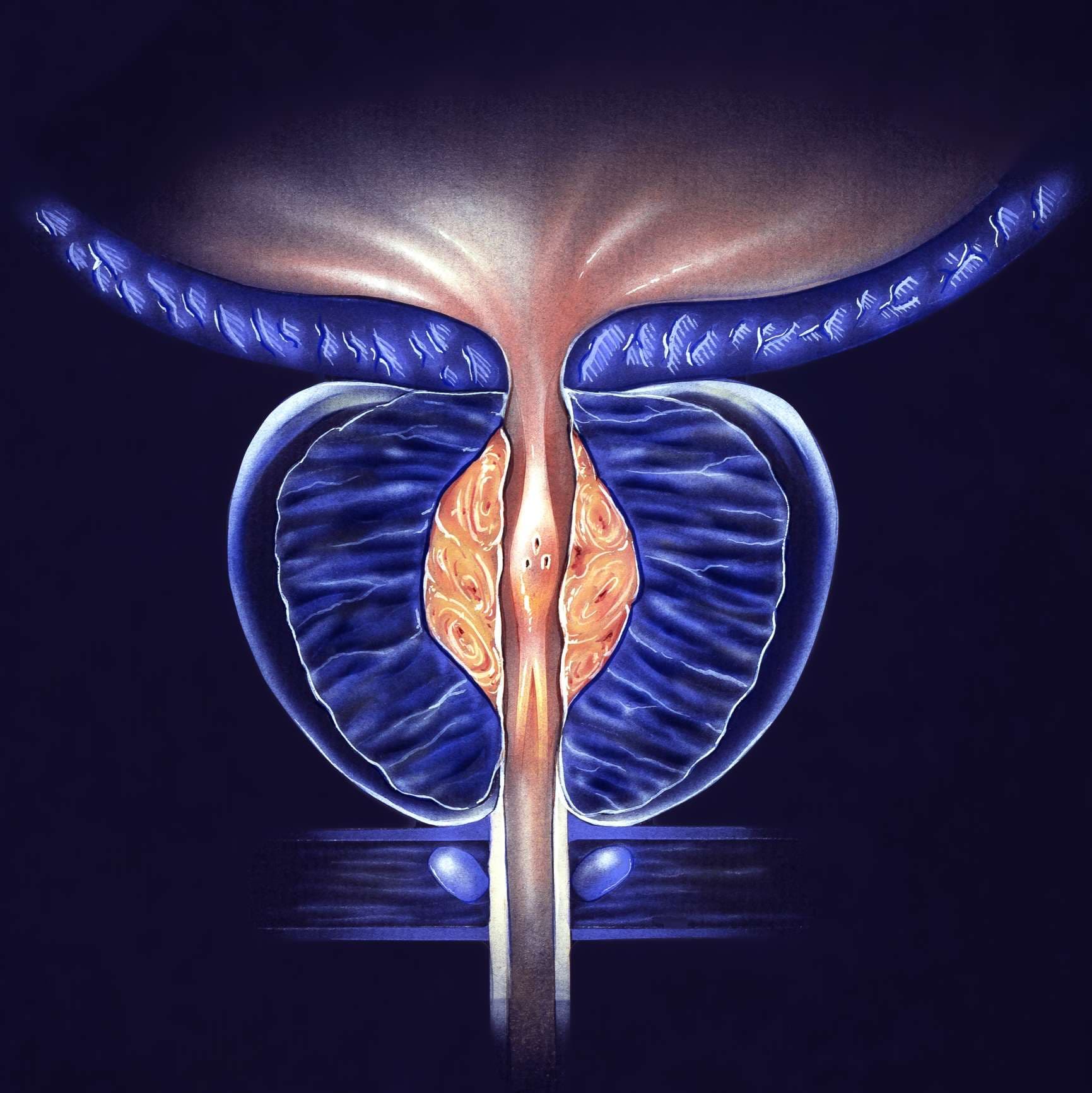 Prostata – (BPH) Benigne Prostatahyperplasie, Stufe 1 – falsche Farbe, um Details hervorzuheben