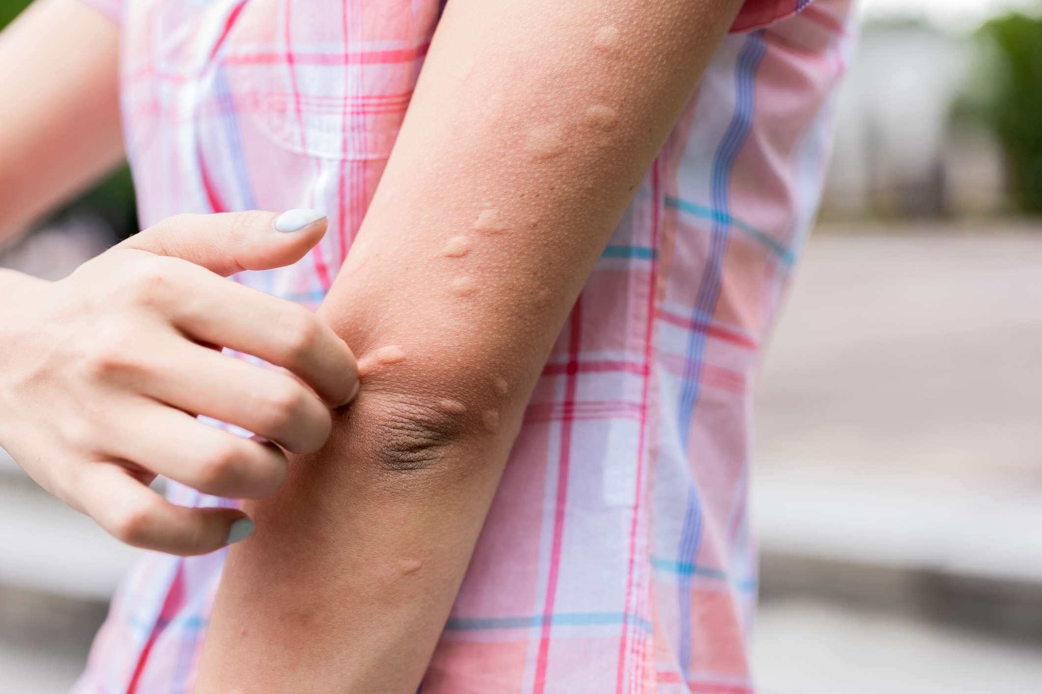 Arm von Gilr wird von der Mücke gebissen und bekommt im Sommer Beulen auf ihrer Haut