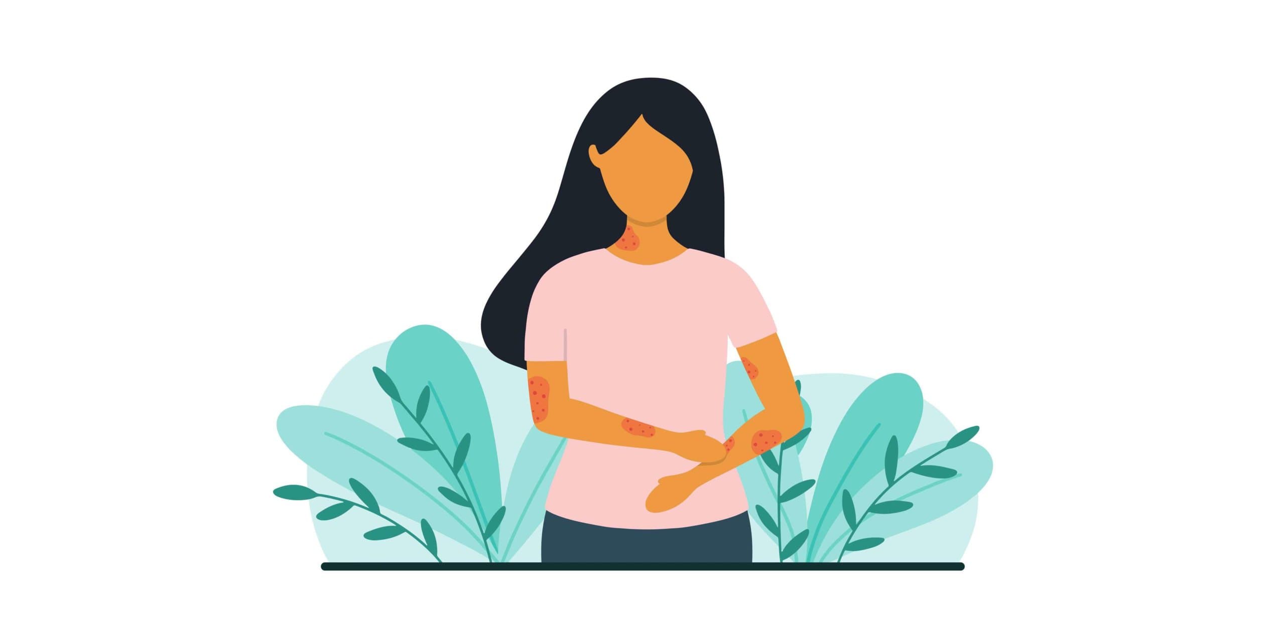 Frau mit Hautproblemen. Psoriasis- oder Ekzemkonzept. Flache Vektorillustration.