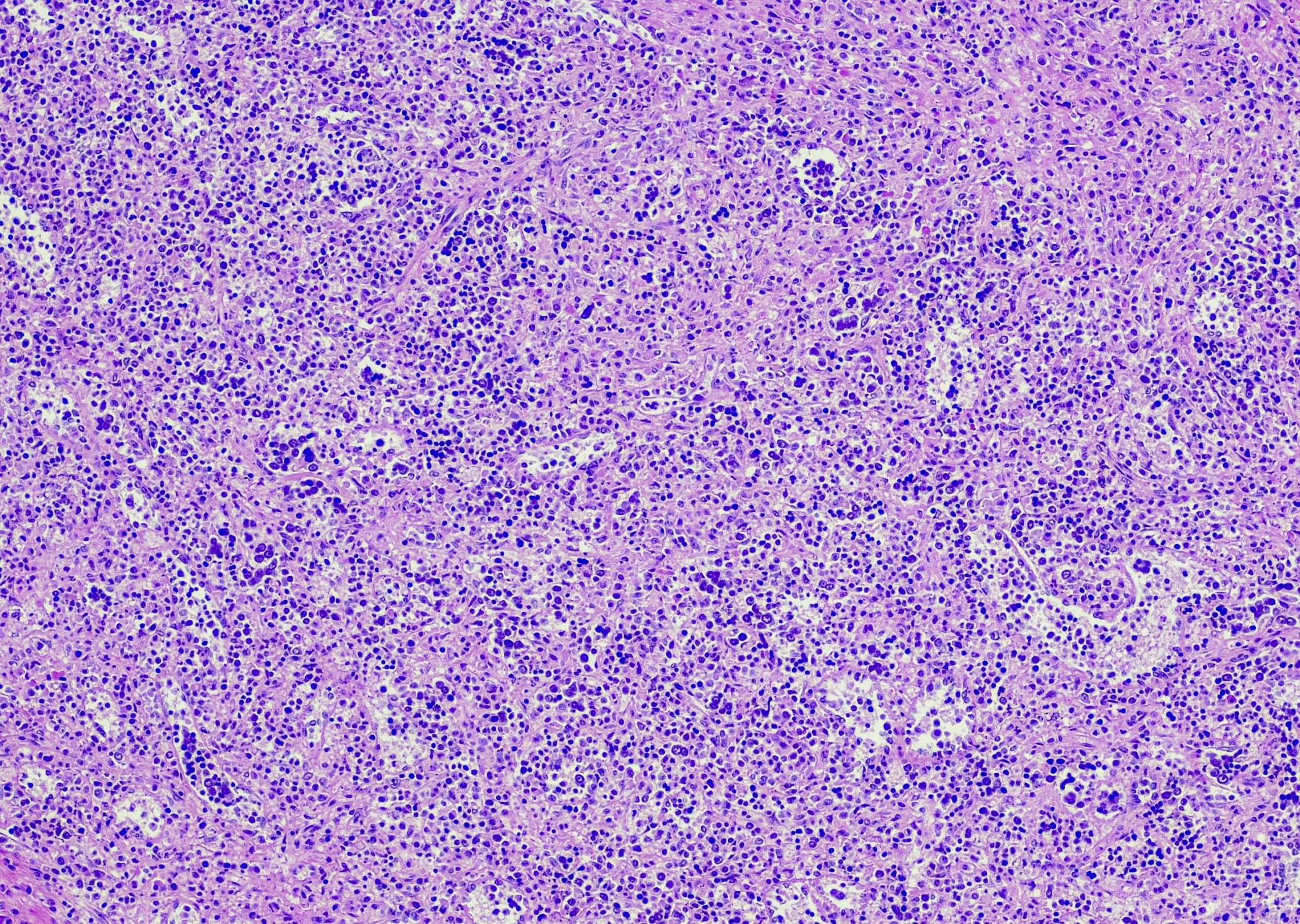 Klassisches Hodgkin-Lymphom, Subtyp mit gemischter Zellularität. Ort: Milz. Gemischte Zellularität ist ein Subtyp des klassischen Hodgkin-Lymphoms, das durch diagnostische Hodgkin-Reed-Sternberg-Zellen in einem gemischten entzündlichen Hintergrund ohne Sklerose gekennzeichnet ist. Einkernig