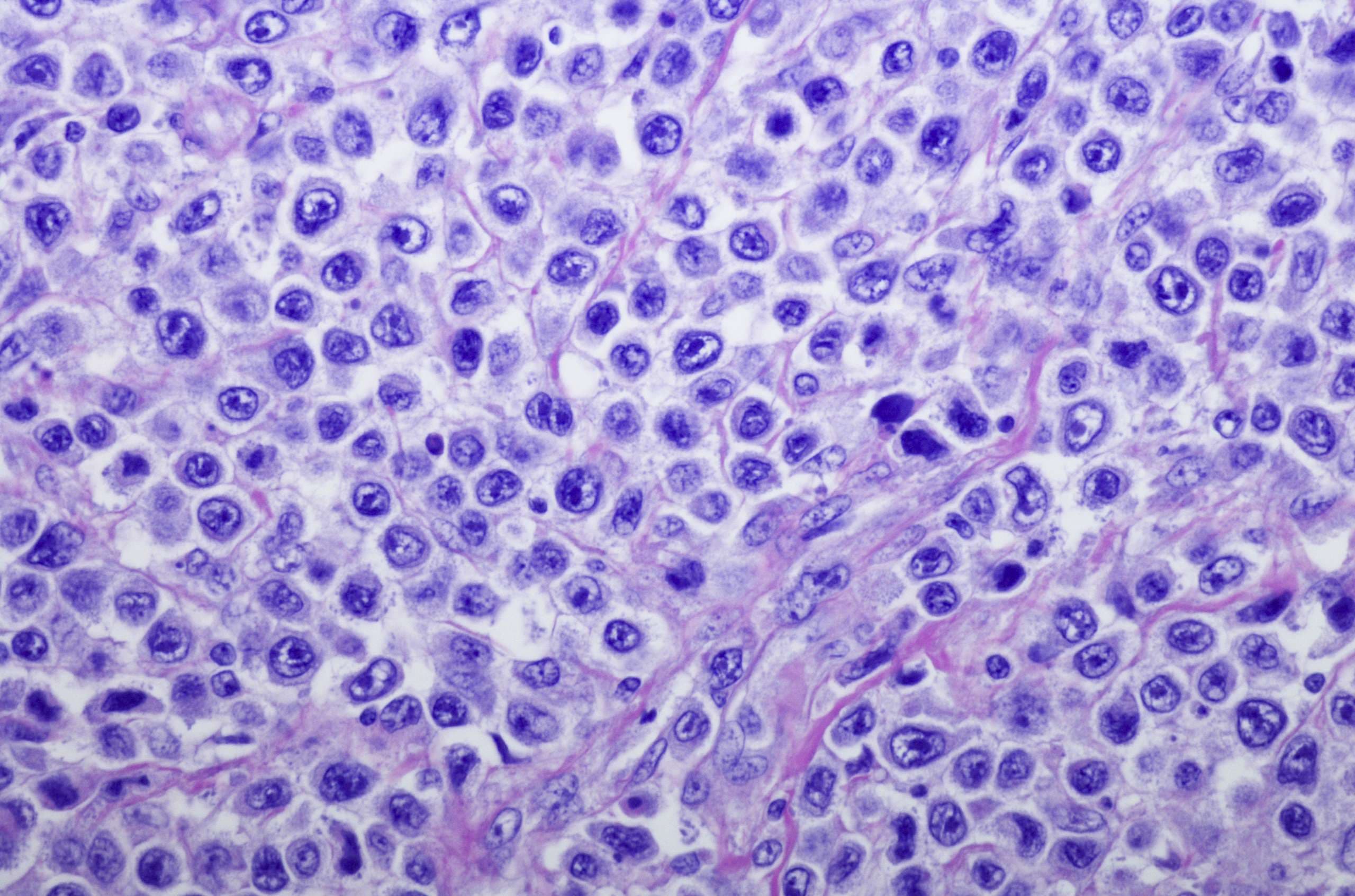 Diffuses großzelliges B-Zell-Lymphom des Magens