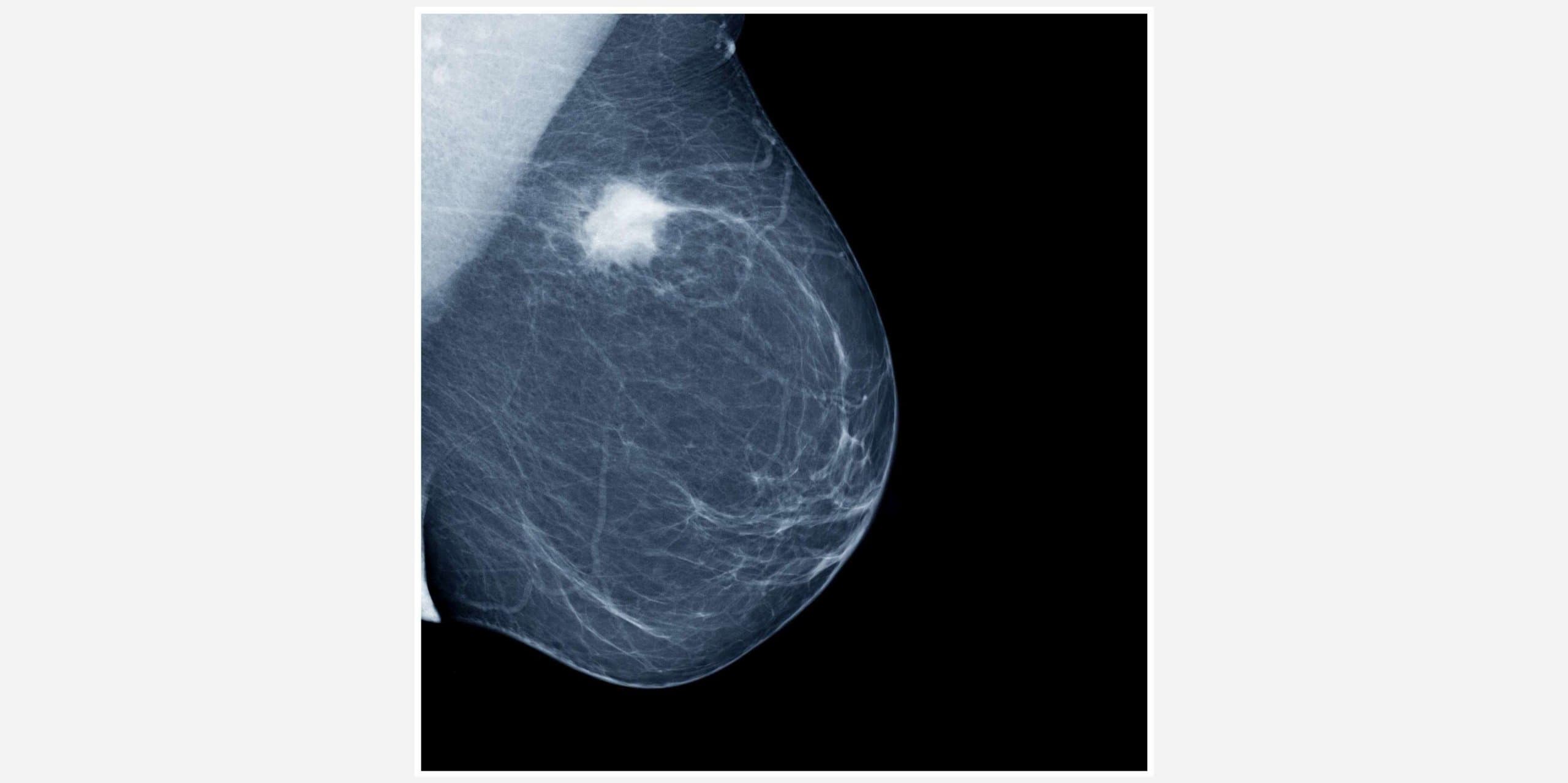 Lateral mammogram of female breast with tumor