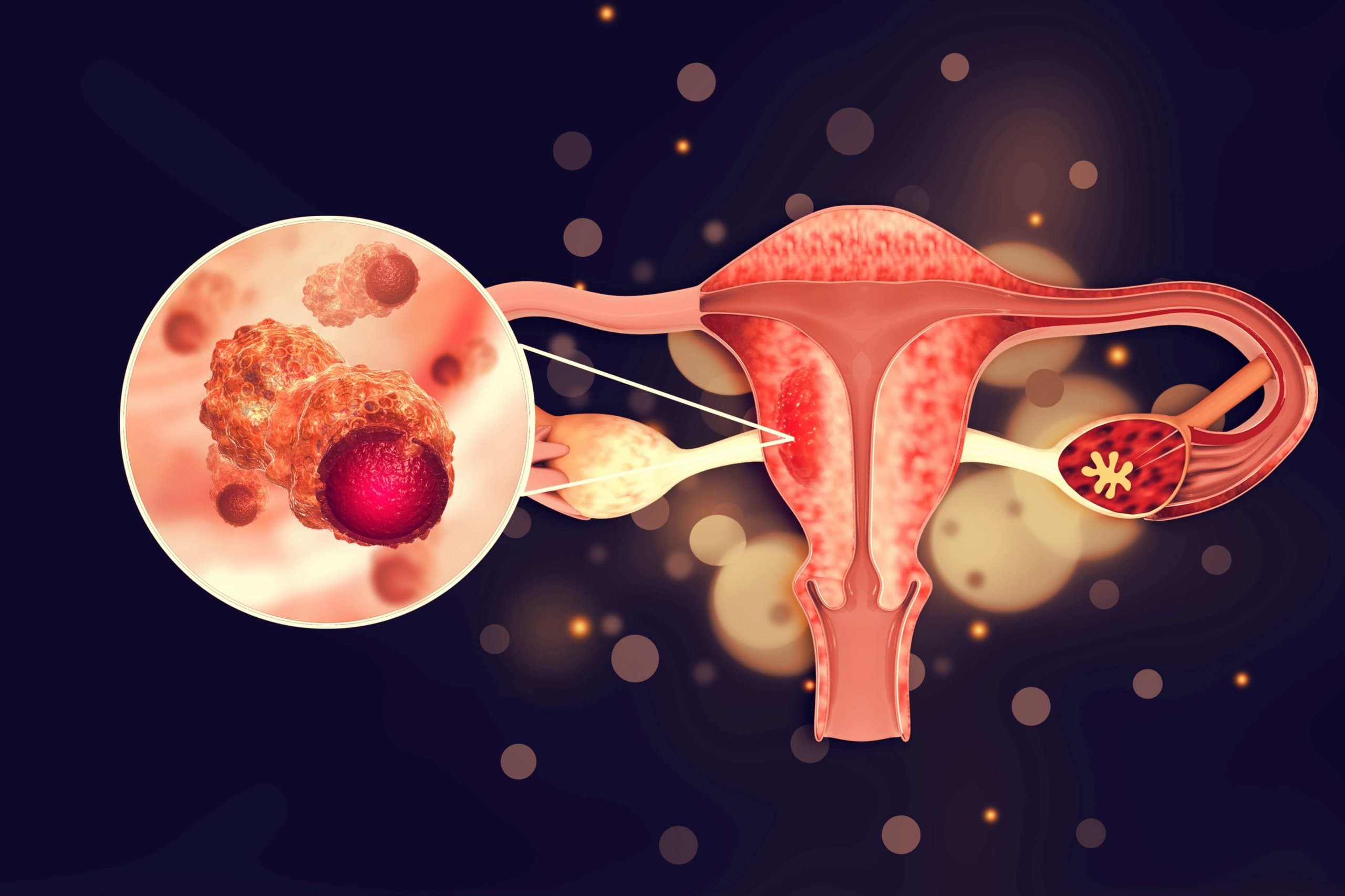 Erkrankungen des weiblichen Fortpflanzungssystems. Gebärmutterkrebs und bösartiger Tumor des Endometriums als uterines medizinisches Konzept. 3D-Darstellung