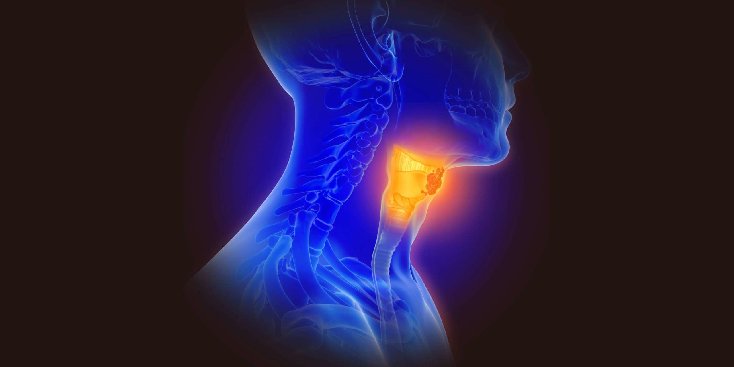 3D-Darstellung von Kehlkopfkrebs