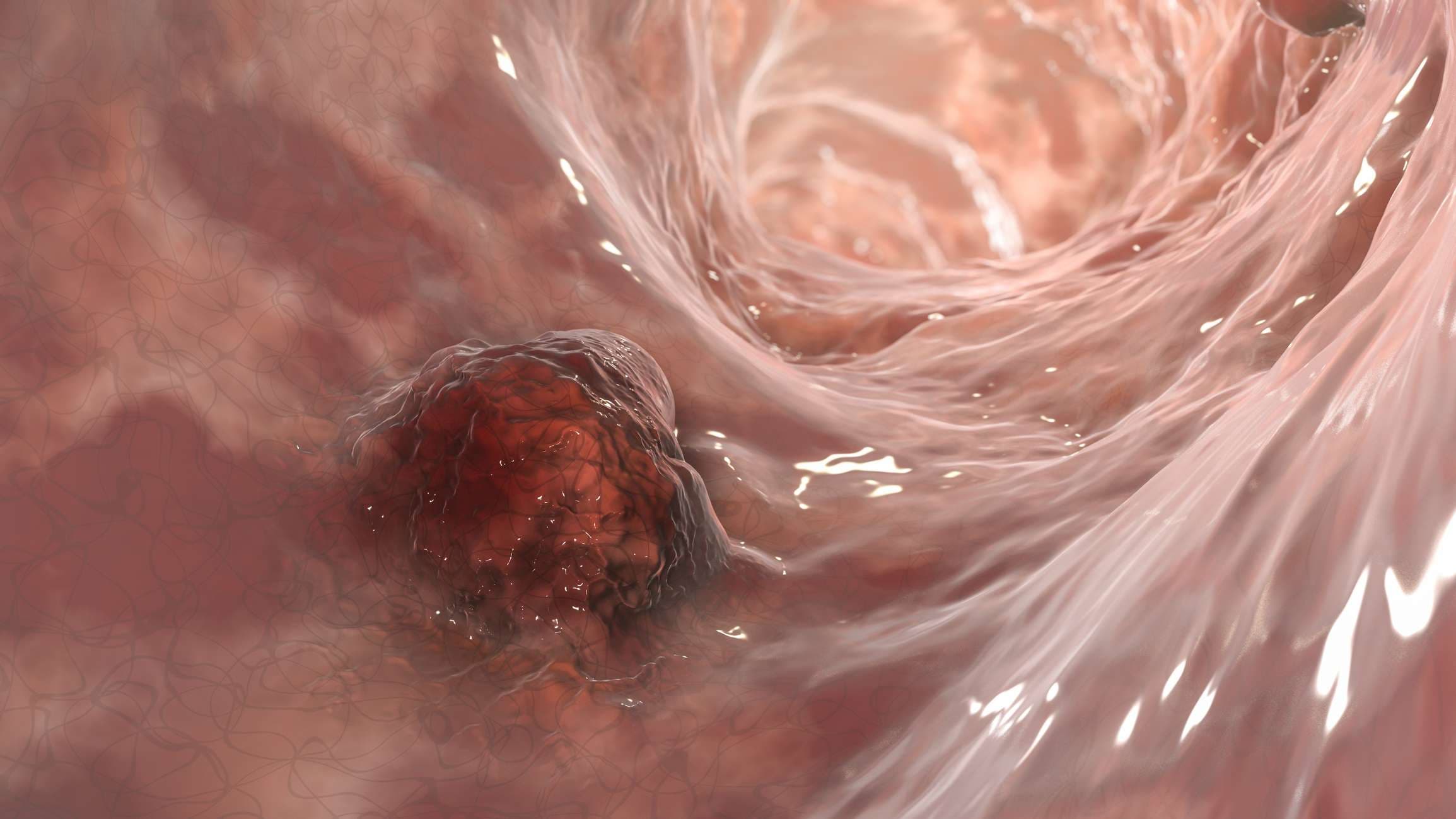Darmkrebs, Darmkrebs, Darmneoplasie, 3D-Darstellung mit bösartigem Tumor im Darm