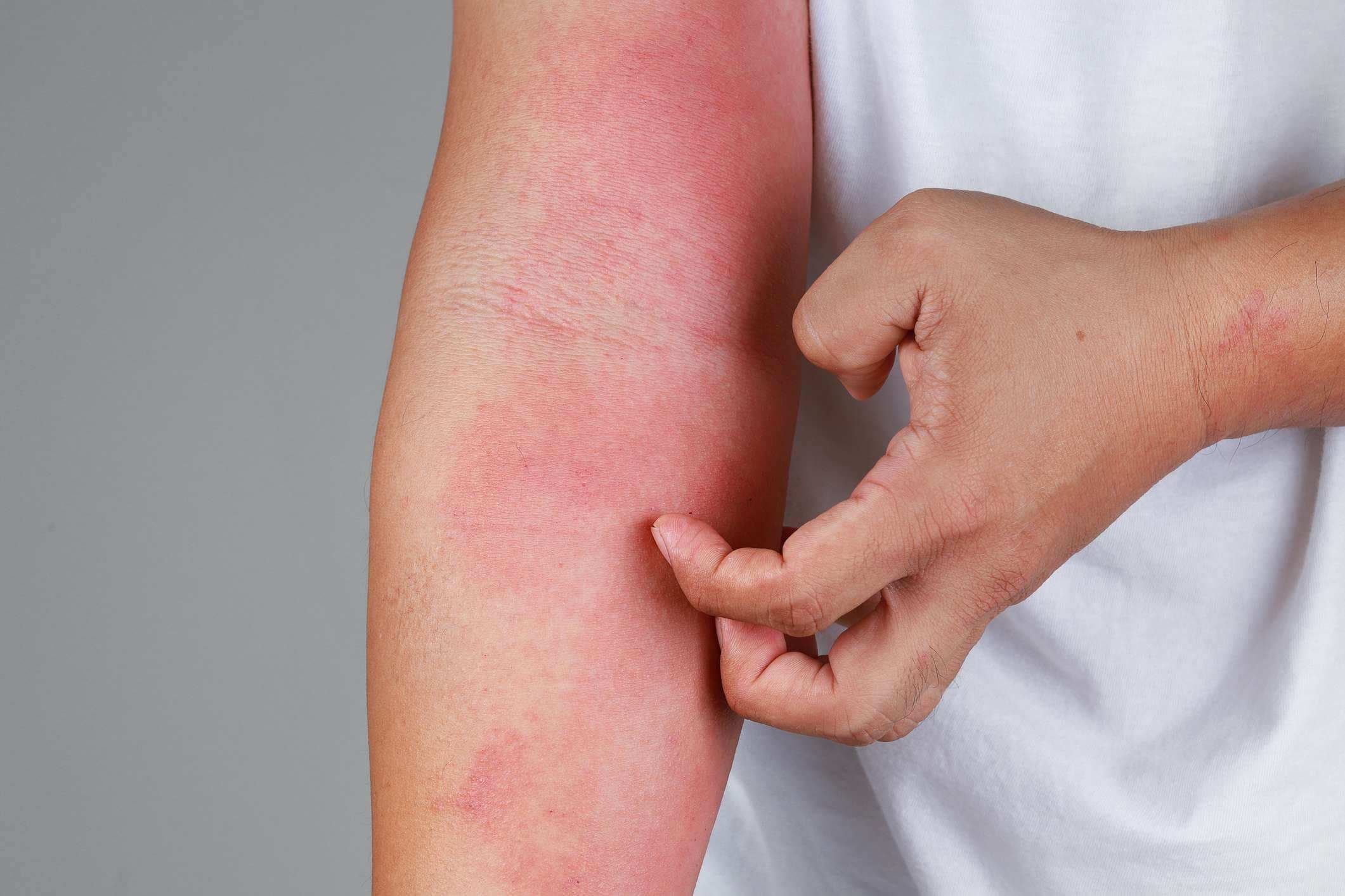 Eine Nahaufnahme einer schlimmen Psoriasis am Arm einer Person