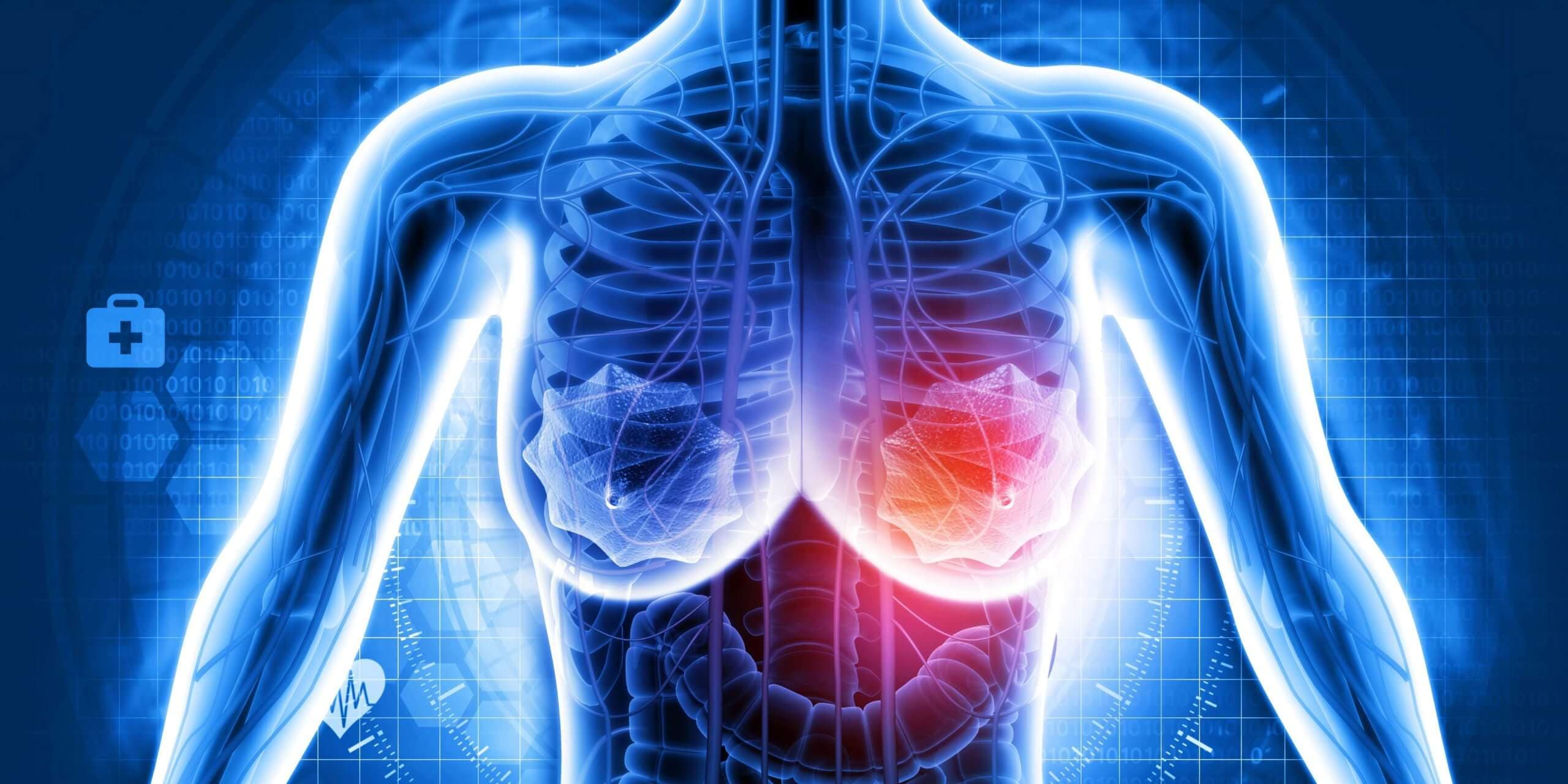 Brustkrebs. 3D-Darstellung