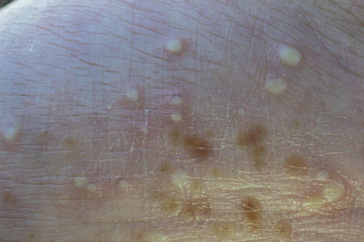 Makrofoto von Pusteln auf der Handfläche, pustulösen Psoriasis-Läsionen, palmoplantarer Psoriasis