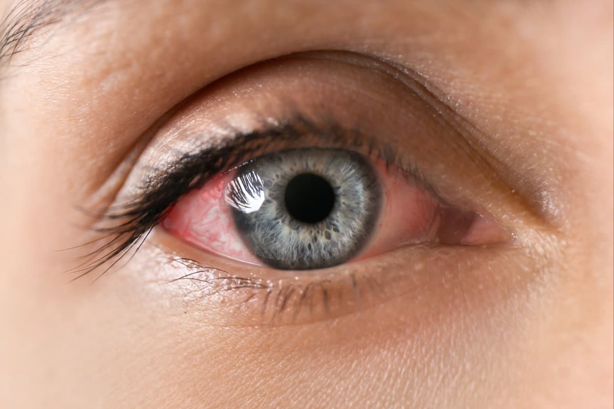 Young woman without and with eye redness, closeup