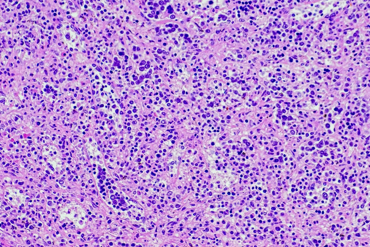 Klassisches Hodgkin-Lymphom, gemischtzelliger Subtyp. Standort: Milz. Gemischte Zellularität ist ein Subtyp des klassischen Hodgkin-Lymphoms, der durch diagnostische Hodgkin-Reed-Sternberg-Zellen in einem gemischten entzündlichen Hintergrund ohne Sklerose gekennzeichnet ist. Einkernig