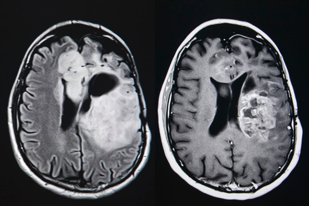 Hirntumor, MRT