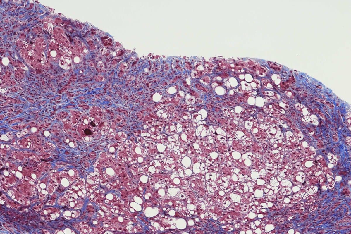 Leberzirrhose mit Lebersteatose und chronischer Hepatitis