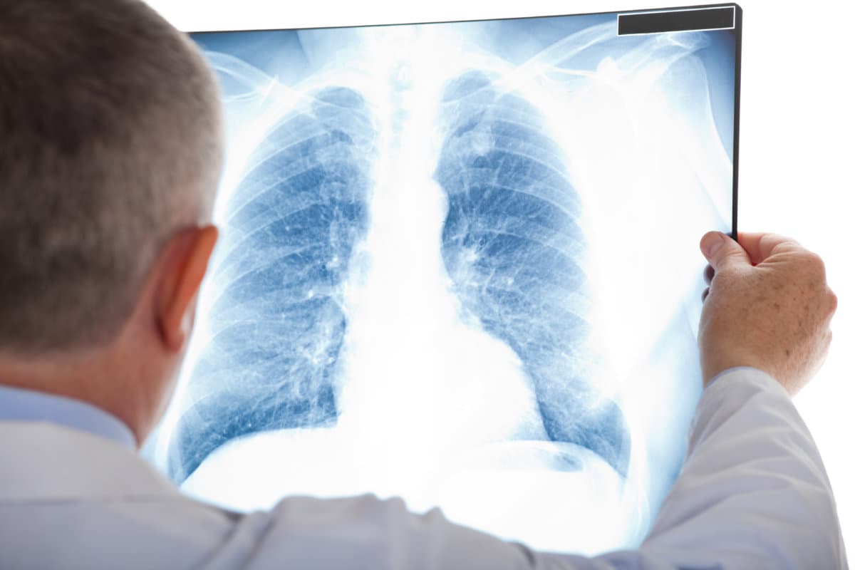 Doctor examining a lung radiography