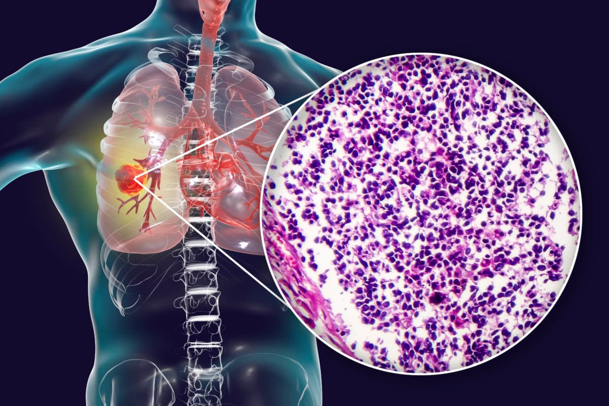 Lung cancer, 3D illustration and photo under microscope. Histopathology light micrograph of small cell lung cancer