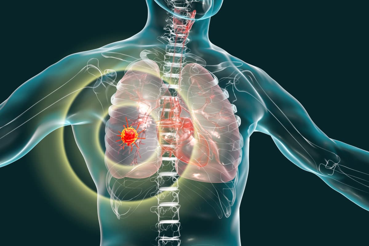 Lung cancer, 3D illustration showing malignant tumour in the ung