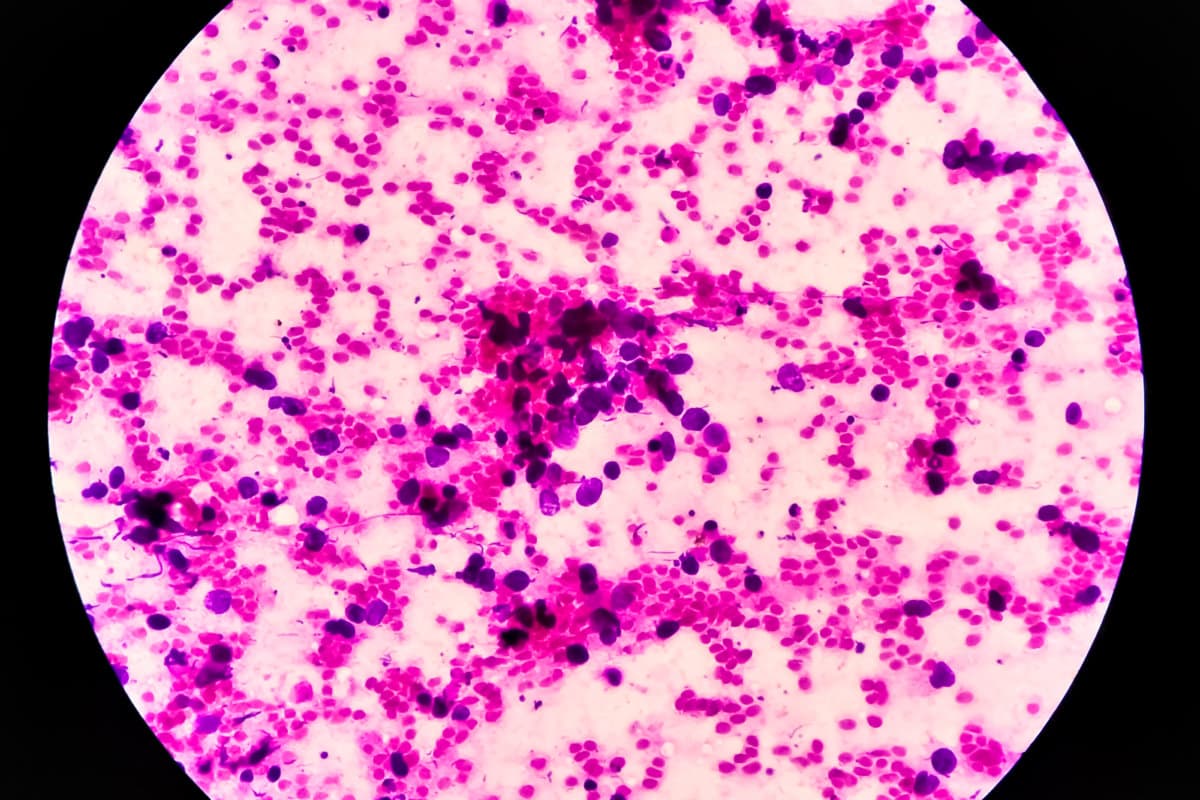 Right lung mass MRI  Guaided FNA microscopic show positive for malignant cell, small cell carcinoma. cytology