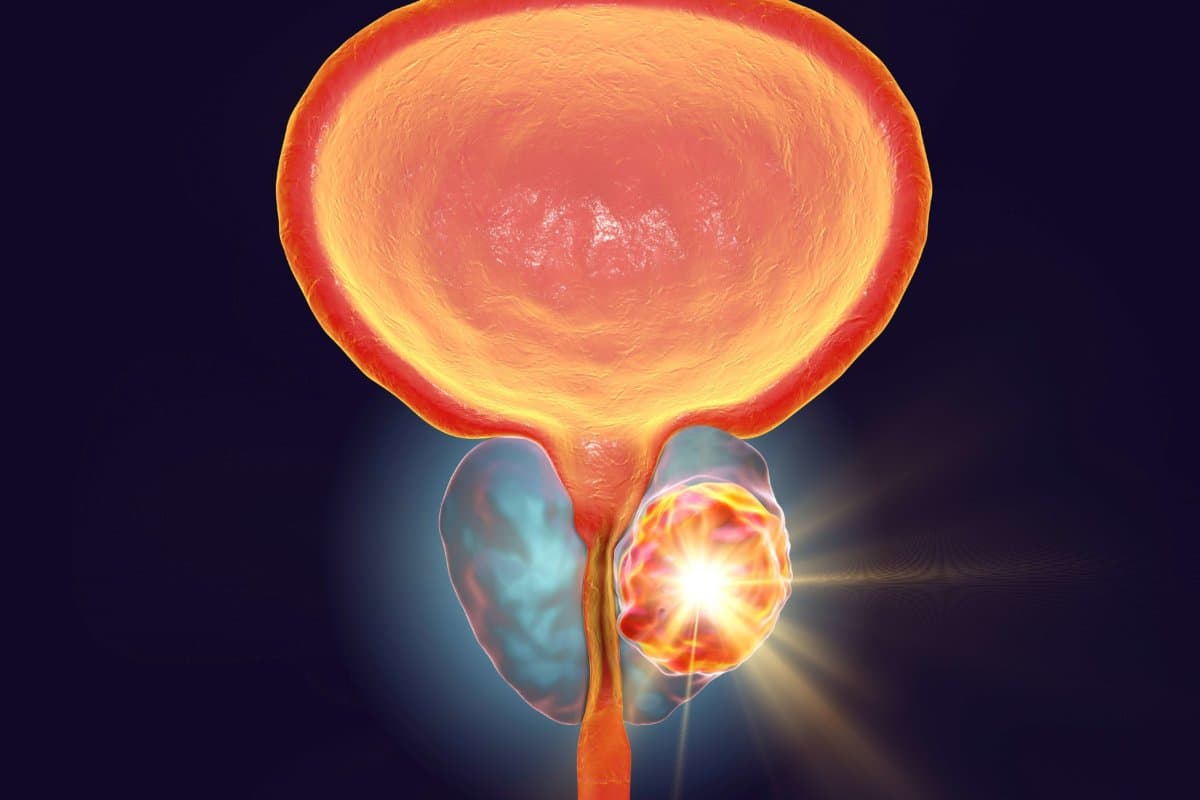 Conceptual image for prostate cancer treatment, 3D illustration showing destruction of a tumor inside prostate gland