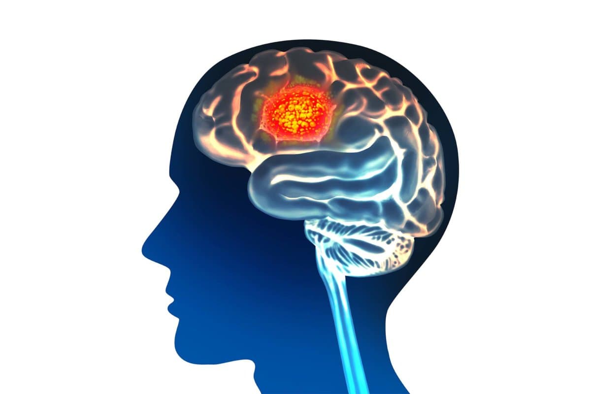 Brain Cancer Anatomy