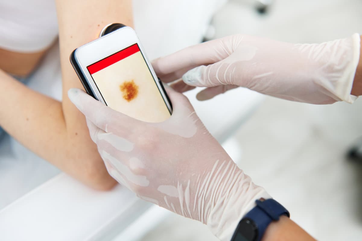 Close-up of a doctor&#8217;s hand holding a dermoscope and examining moles on the patient&#8217;s arm. Cancer early diagnosis and prevention concept. Dermatoscopy, prevention of melanoma, skin cancer.