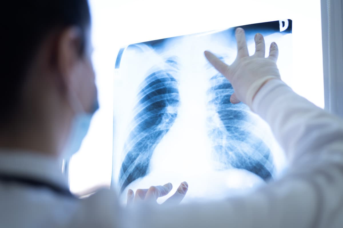 Pulmonologist looking at lung x-ray prescribing treatment to patient, healthcare