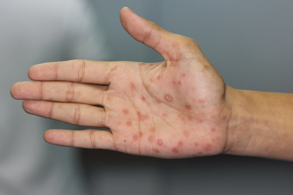 Secondary stage syphilis sores (lesions) on the palms of the han
