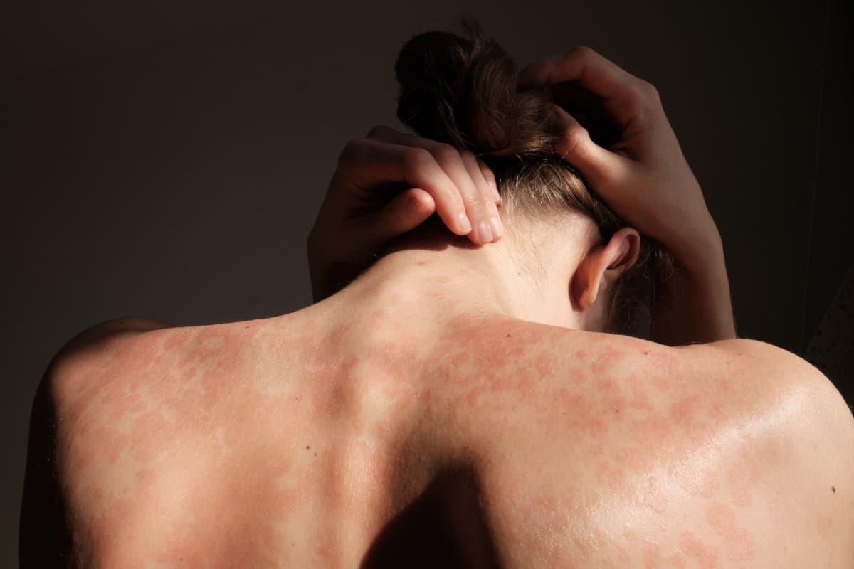 Close-up woman touches herself. Neck, back, spine. Psoriasis ski