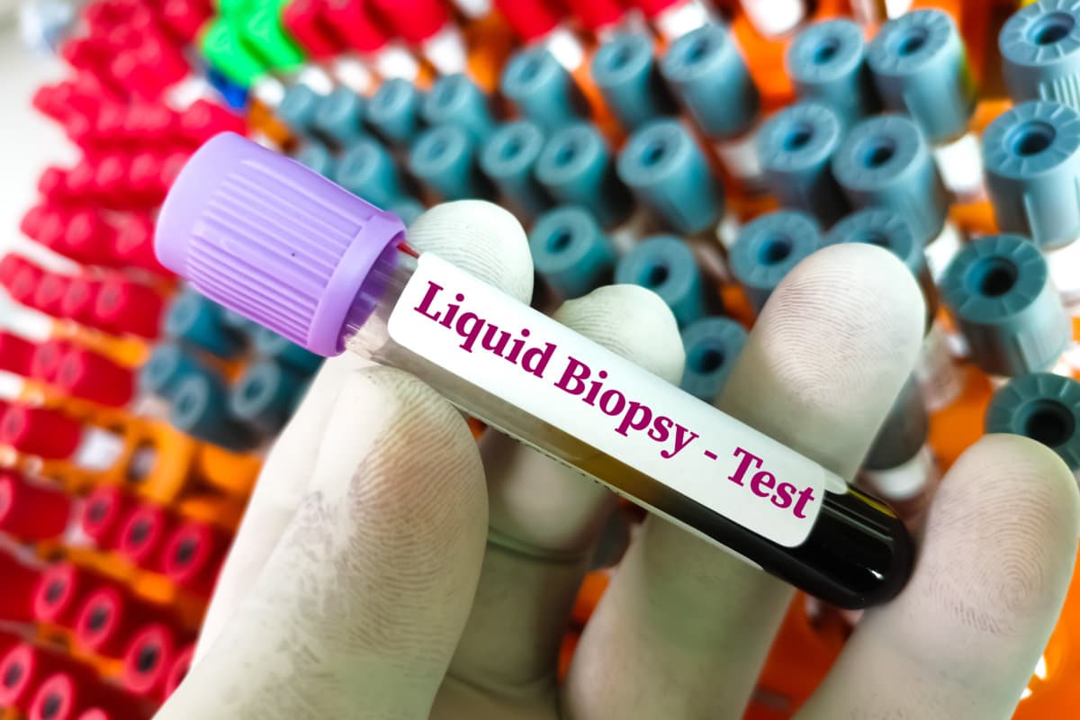 Blood samples for Liquid biopsy blood test to detect cancer cells or DNA fragments that circulate in the bloodstream, Lung cancer, laboratory background